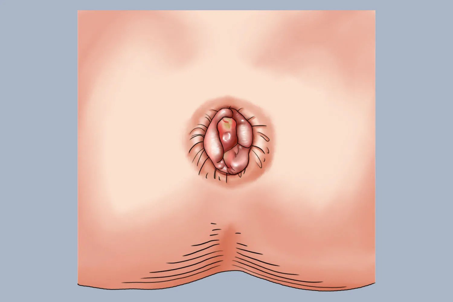 女性痔疮是什么样子的图片