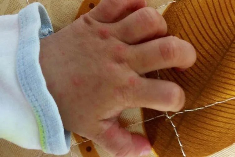 宝宝手足口病的症状图