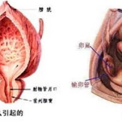 女人为什么要取环