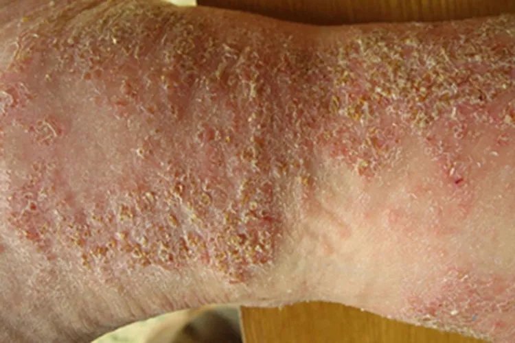 皮肤过敏红肿手腕黄痂图片