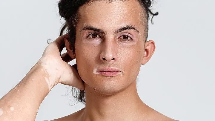 白癜风的发病原因有哪些