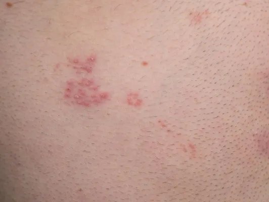 祛痘痘印的方法有哪些