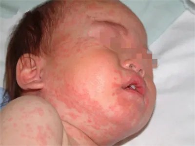 典型麻疹出疹期症状图片