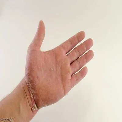 雷诺病应注意什么