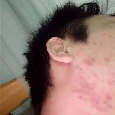 青春痘平时怎么护理