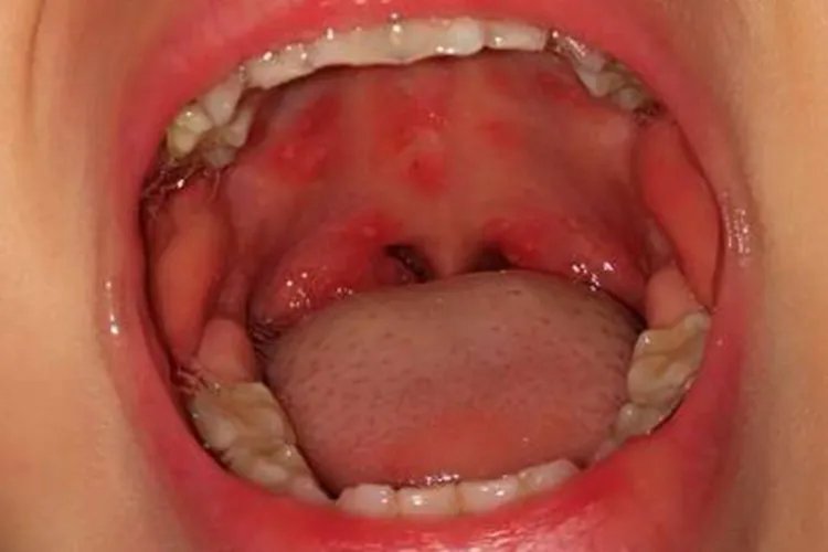 手足口病症状初期图片,痒不痒