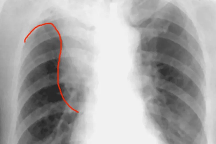 肺鳞癌图片什么样子