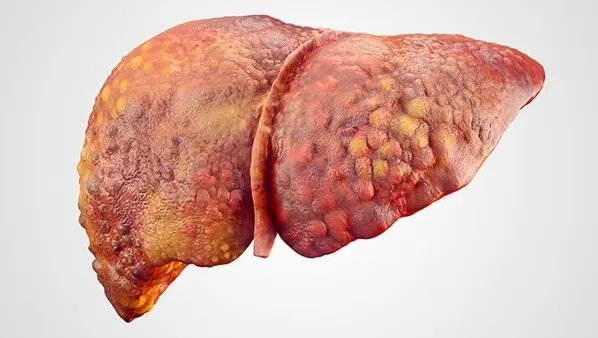 脂肪肝的自然疗法