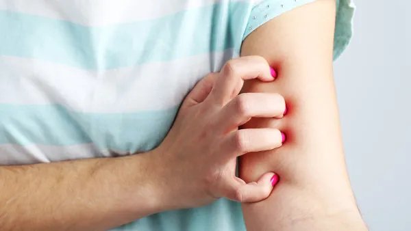 皮肤过敏了怎么办