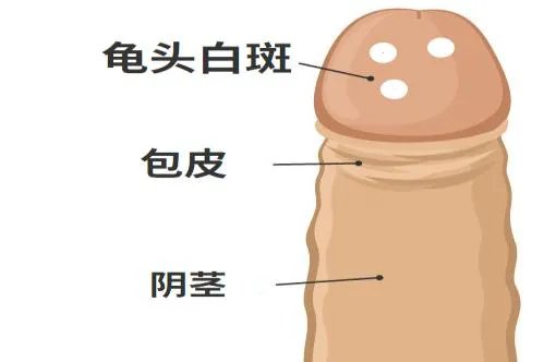 龟头感染霉菌症状图片
