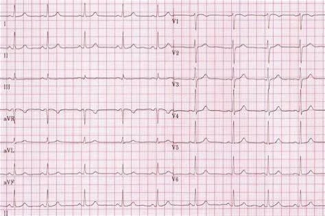 正常心电图图片