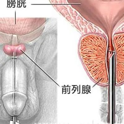 泌尿系统感染有什么症状