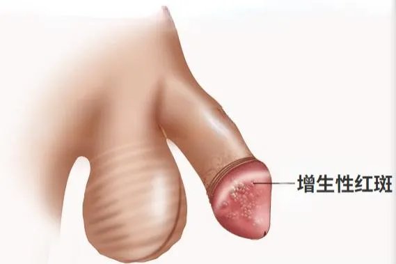 龟头感染霉菌症状图片