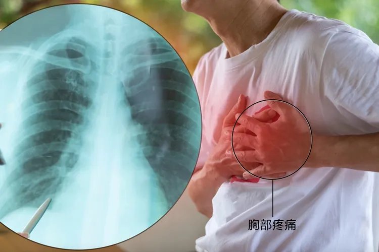 胸膜炎的症状与表现图