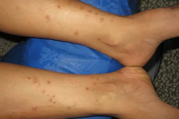 被血吸虫咬了的人图片