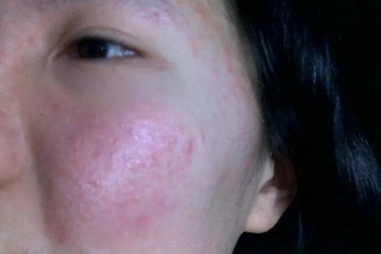 化妆品过敏的症状有哪些表现图片