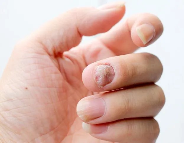 最轻微的灰指甲图 灰指甲轻微症状图片精选