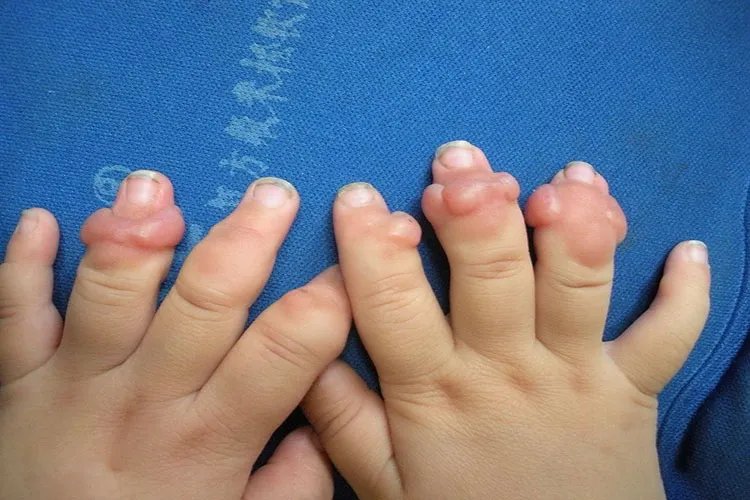 纤维瘤长什么样图片