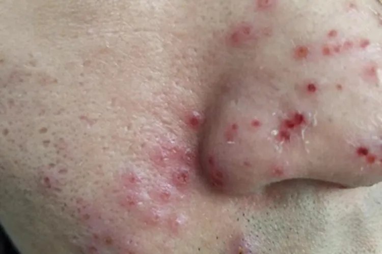 化妆品过敏的症状有哪些表现图片