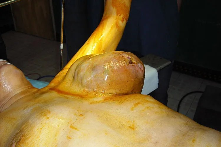 纤维瘤长什么样图片