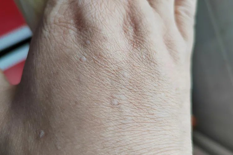 什么叫扁平疣，长什么样