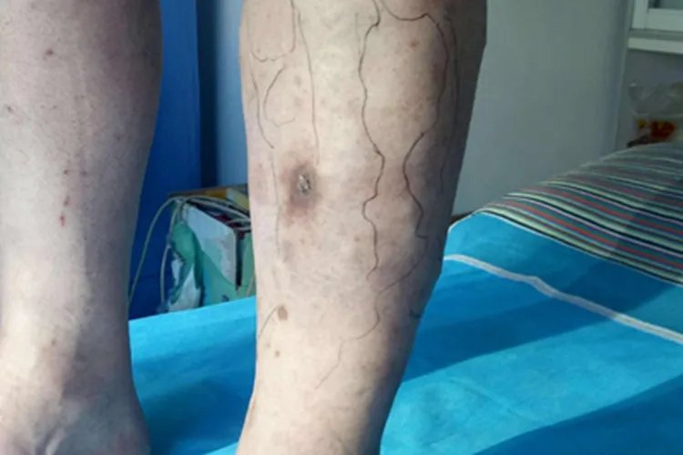 下肢静脉曲张小腿症状图片