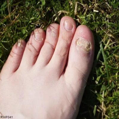 患上灰指甲要怎么自我治疗 治疗灰指甲3自我疗法分享