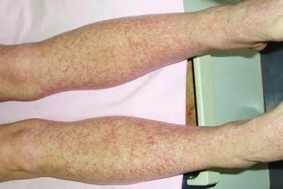 糖尿病出血性紫癜图片