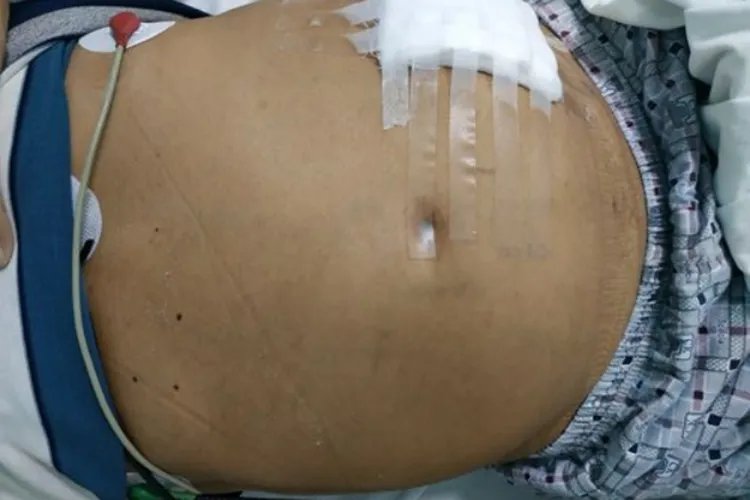 肝腹水的早期症状表现有哪些图片