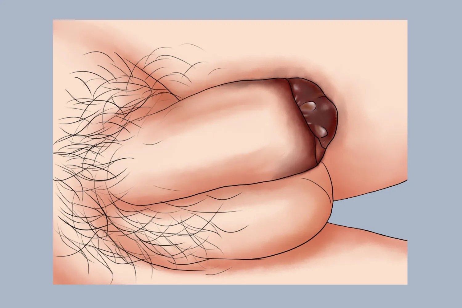 环切术后水肿严重图片