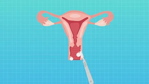 骨纤维肉瘤是什么