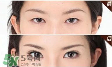开外眼角前后对比照_开外眼角前后效果对比图