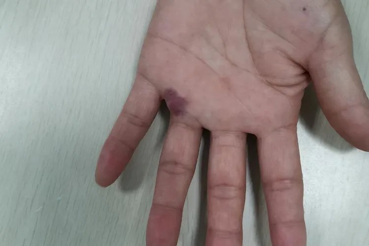 红斑狼疮对照图