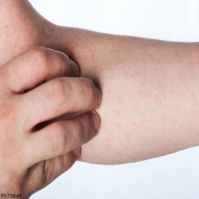 恙虫病有什么症状