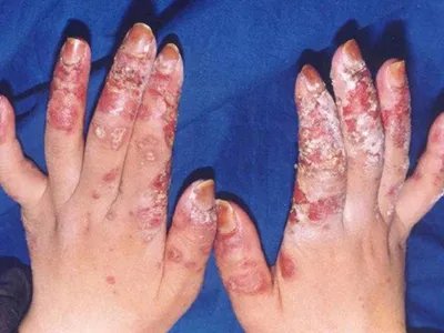 系统性红斑狼疮红斑图片