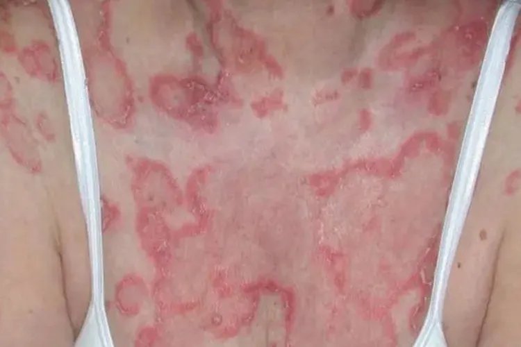 红斑狼疮对照图