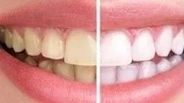 牙齿美白的方法有哪些呢？