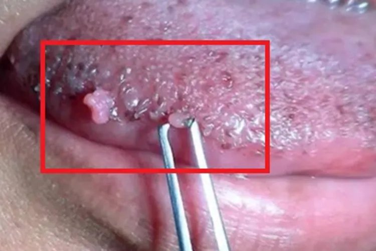 女性疣疙瘩图片