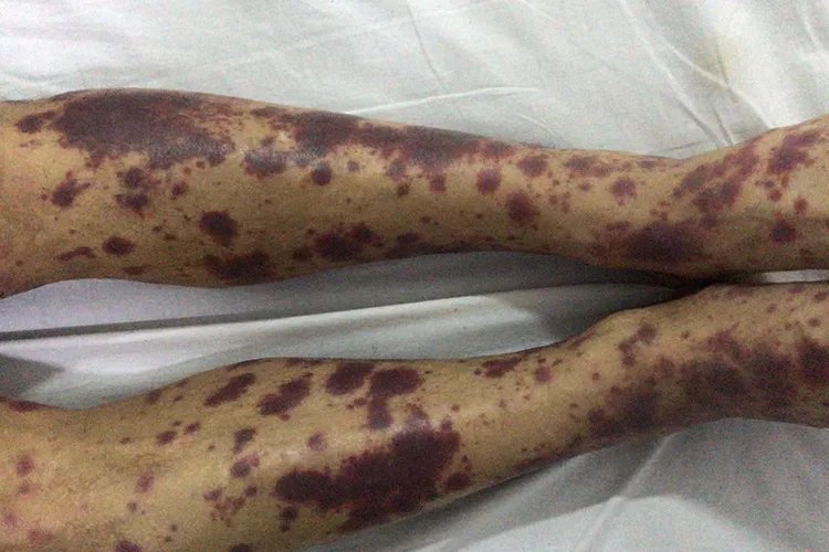 紫癜图片和症状