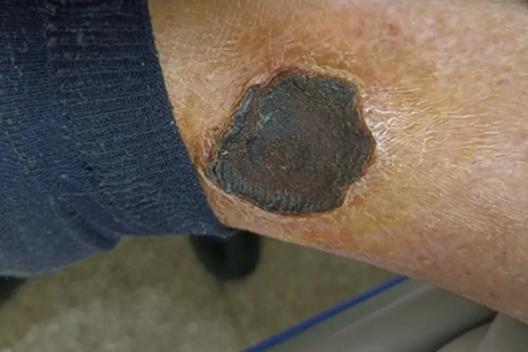 干性坏疽症状图片