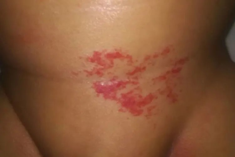 小孩血管瘤图片