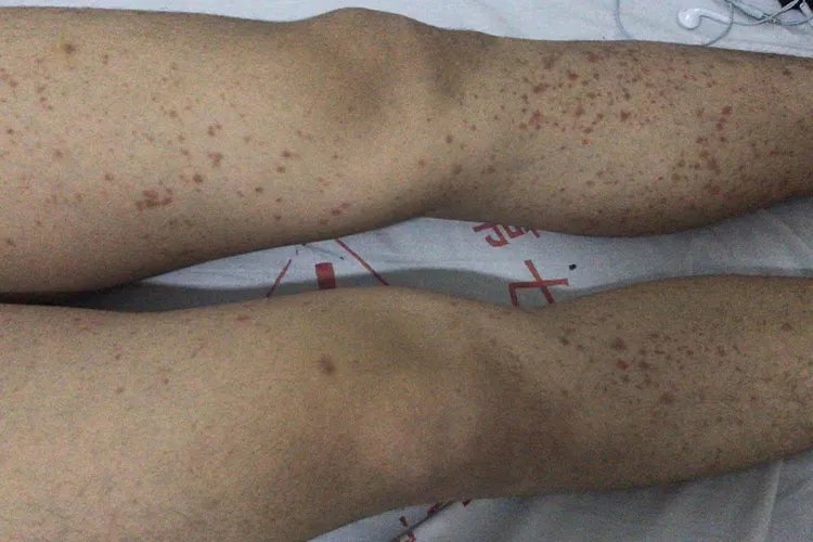 紫癜图片和症状