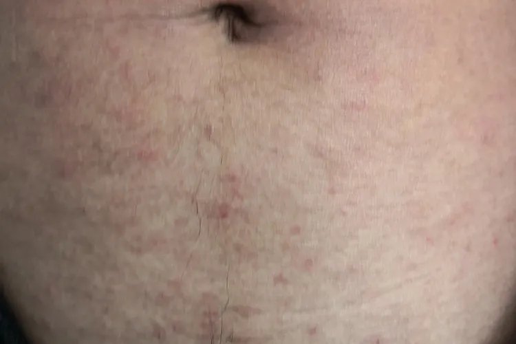 疥是什么皮肤病图片大全