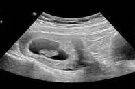 b超照片怀孕初期图片