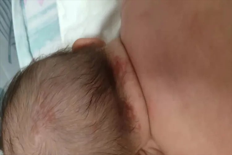 小孩血管瘤图片