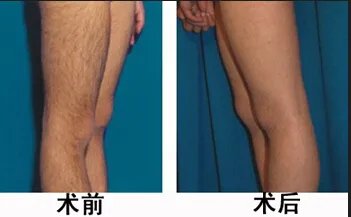 北京市光子脱毛的价格