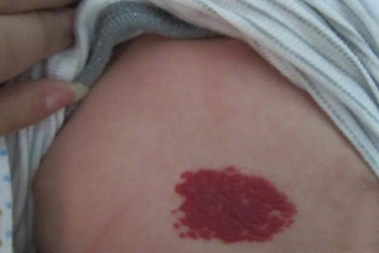 小孩血管瘤图片