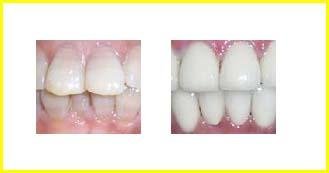 黄牙变白牙需要多少钱