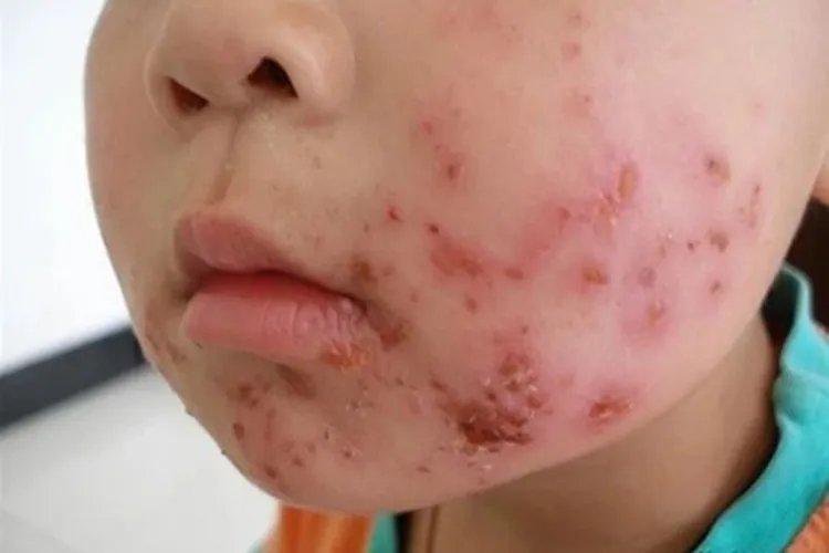 脓疱疮症状图片