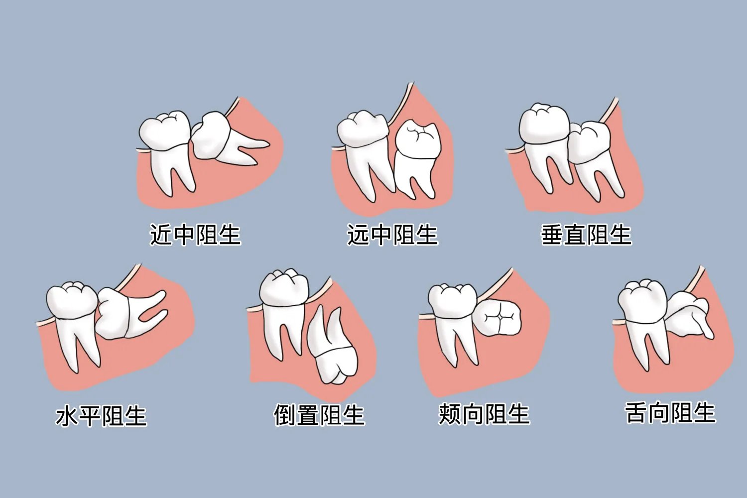 最难拔的智齿图片